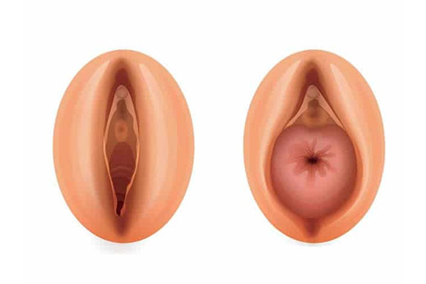 Prolapsus (Rahim ve Vajen Sarkması) Nedir?